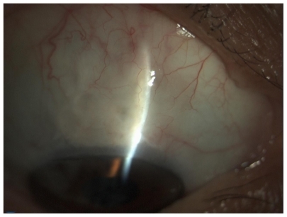 Figure 6 Appearance of bleb with cysts (E2-V1-H2).