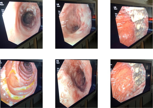 Figure 3. Endoscopic images from the patient's electronic medical record. Obtained with patient permission.