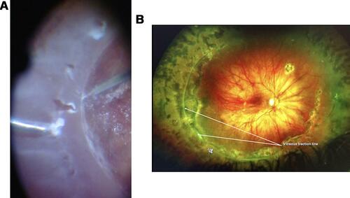 Figure 8 (A) Intraoperative image of seven post equatorial retinal tears extending from 8 to 10 o’clock temporally along a prominent circumferential line of vitreous traction, causing total RRD in the right eye of a 14-year-old female with STL1, congenital extreme myopia (26 diopters), and abnormal vitreous (Video S3). These tears occurred well posterior to standard OSC prophylaxis performed 4 months previously. (B) Postoperative image of the same retina reattached under silicone oil, with corrected visual acuity in the eye of 20/30. Note the prominent line of vitreous traction from 5 to 11 o’clock that could not be safely removed during the initial repair despite retinal stabilization with perfluorocarbon liquid. Laser retinopexy extends quite posteriorly to encompass all tears and the traction line that was further reduced upon silicone oil removal.
