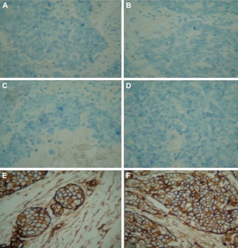 Figure 7 Expression of CD44st and HER-2 proteins in breast cancer tissues (×400).