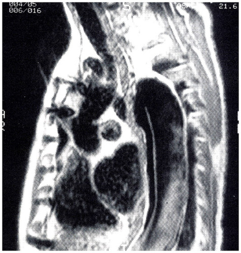 Figure 2 Magnetic resonance angiogram image of an acute type B aortic dissection. Note the intimal flap on the anterior aorta.