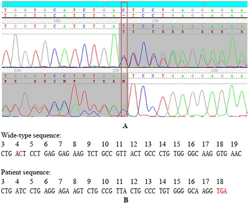 Figure 2. The results of the variant confirmed by Sanger sequence and its effect for the transcription process of β-globin gene. (A) Forward and reverse sequence data of the β-globin gene confirms the codon 4 deletion mutation in the heterozygous state and the deletion results in numerous ambiguities (peaks overlapping). (B) Nucleotide sequence of the β-globin gene on exon 1, codons 3–19. Note the frameshift change starting at codon 4 that results in a premature stop codon at position 18.