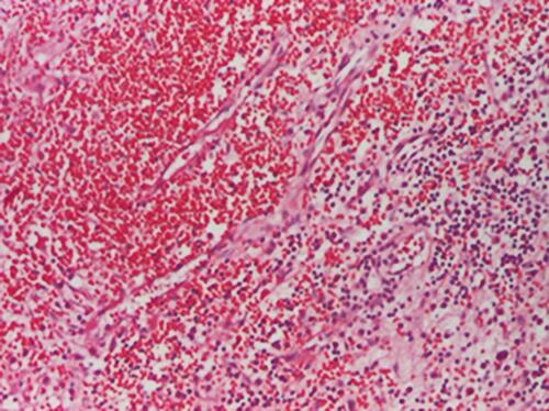 Figure 6 Hemato-fibrino-leukocyte exudate on the surface and fibrosis on the wall (HE stain, x40).