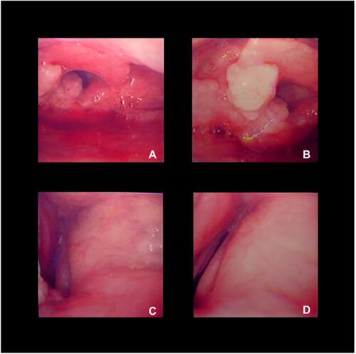 Figure 1 Nasoendoscopy in acute dyspneic hypoxia with stridor. Top left, (A) glottis edema and hyperemia with laryngeal mass filling the airway; top right, (B) a vegetant and tough mass infiltrating the epiglottis and left arytenoid causing sub-total airway obstruction; bottom left, (C) obstructive edema of the true and false right vocal cords; and bottom right, (D) obstruction of the laryngeal aditus with vocal cords in blocked adduction.