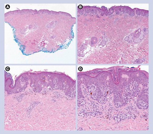 Figure 5. Spitzoid dysplastic nevus.(A) Small and circumscribed lesion (20×). (B & C) Epidermal hyperplasia and bridging of junctional nests (40× and 100×, respectively). (D) Horizontal bridging of junctional nests with concentric fibroplasia and mild dermal inflammation. The melanocytes are epithelioid. Kamino bodies are present (200×).