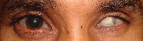 FIGURE 1  Clinical image showing that, at presentation, the patient had phthisis in the left eye. The cornea in the right eye appears large and the pupil is pharmacologically dilated. A Descemet membrane break can be seen inferotemporally. The sclera does not appear blue.