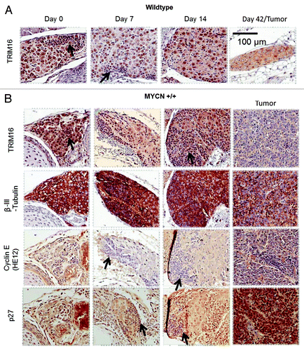 Figure 1. TRIM16 protein has nuclear localization in differentiating ganglia cells but is reduced in neuroblastoma tumors in vivo. Wild-type (wt) mice and homozygous TH-MYCN mice were culled at day 0, 7, 14, 42 time points. At day 42, only the transgenic mice have tumors. Parafilm-embedded paravertebral ganglia tissues were sectioned, and consecutive slides were used for immohistochemistry. Proteins of interest were stained by antibody conjugated to DAB (brown) stain and counterstained with hematoxylin (blue). β-III-tubulin (neuronal maker), cyclin E (G1/S marker), p27 (G0, G1 and neuronal differentiation marker) antibodies were used. The arrows show areas of hyperplasia/tumor initiating neuroblasts. Representative images are 40× captured with Aperio ScanScope XT.