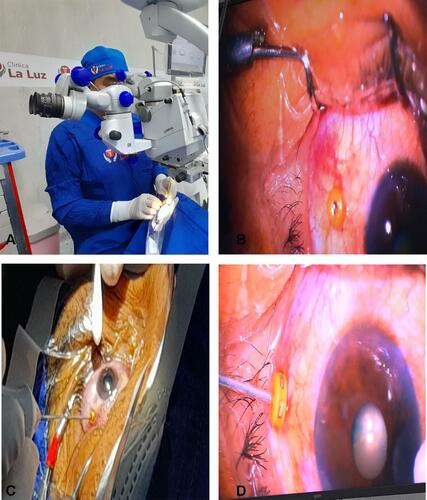 Figure 1 (A) The surgeon places the trocar using a swab to support the eye. (B) The placed trocar is visualized. (C) The vitrector of the Alcon Centurion® is introduced. (D) Posterior vitrectomy is performed for 10 seconds, counting the clock, with cuts of 2000 cfm, in a vacuum of 150 mmHg, with the vitrector tip pointing down so as not to touch the posterior capsule and to minimize the risk of hitting the retina.