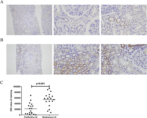 Figure 2 MPC2 expression in kidney tissues of LN. Representative immunohistochemical staining of MPC2 in proliferative LN ((A), n=18), and membranous LN ((B), n=18) groups, respectively. Left column (Magnification×100). Right two columns (Magnification×400). (C) shows a comparison of quantitative analysis of MPC2 expression between proliferative LN and membranous LN using Image-Pro Plus 6.0 software.