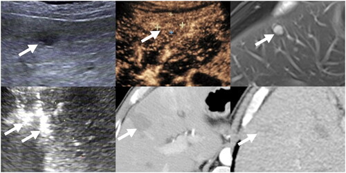 Figure 5. Images from a 60-year-old male with liver metastasis from GIST. (A) Ultrasound before RFA showed a 1.6 cm tumor in liver. (B) Contrast-enhanced ultrasound before RFA showed a 1.8 cm tumor with slight enhancement in liver. (C)MRI showed a 1.8 cm enhanced tumor (arrow) in liver. (D) with ultrasound guidance, two bipolar RFA electrodes (arrow) were inserted into the tumor (E)Contrast-enhanced CT one month after initial RFA showed ablation area showed ablation area had no viability. (F) Contrast-enhanced CT 6 months after initial RFA showed ablation area shrunk without local progression or new liver metastases.