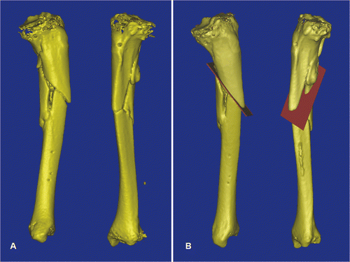 Figure 4. For Patient 2, a 3D model of the left tibial fracture non-union with deformity was generated from the MIMICS software (A). The plane of the osteotomy (red) was then planned at the fracture line in the reconstructed 3D tibial model (B).