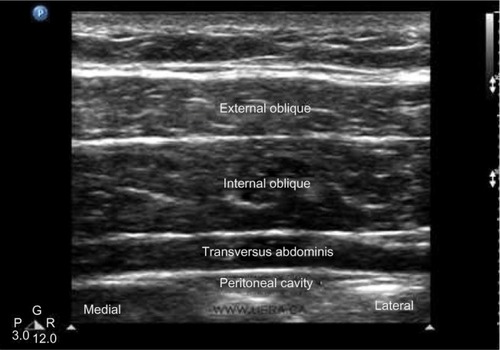 Figure 3 Ultrasound view.