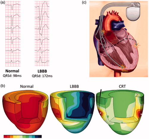 Figure 1. Combined explanatory figure of dyssynchrony and resynchronization in HF. Electrical dyssyncrhony, evident as LBBB on ECG (A), results in an abnormal left ventricular (LV) electrical activation with early- and late-activated regions. Figure 1(b) displays a homogenous electrical activation pattern in the heart with normal intrinsic conduction (left panel). During LBBB activation (middle panel), septum is activated early while the LV lateral wall is activated late. However, these regional differences in electrical activation are ameliorated when CRT is activated (right panel) [Citation3]. Figure 1(c) depicts a CRT-device with one atrial and two ventricular leads. Figure 1(b) is reprinted from ref. [Citation3]. Copyright © (2012), with permission from Elsevier. Figure 1(c) is reproduced with permission of Medtronic, Inc.