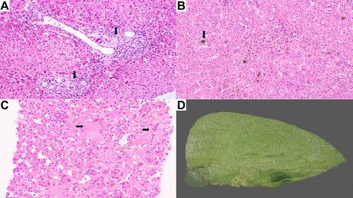 Figure 1 (A) Liver biopsy displaying paucity of interlobular bile ducts (arrow, H&E, ×40). (B) Hepatocanalicular bilirubinostasis (arrow, H&E, ×15). (C) Liver biopsy displaying giant cell formation (arrow, H&E, ×20). (D) Explant liver with cholestasis.