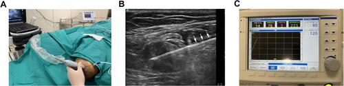 Figure 4 Radiofrequency ablation (RFA) treatment of PAP. (A) Ultrasound-guided RFA procedure. (B) RFA needle was advanced into the neuroma, arrow showed the needle. (C) Radiofrequency generator.