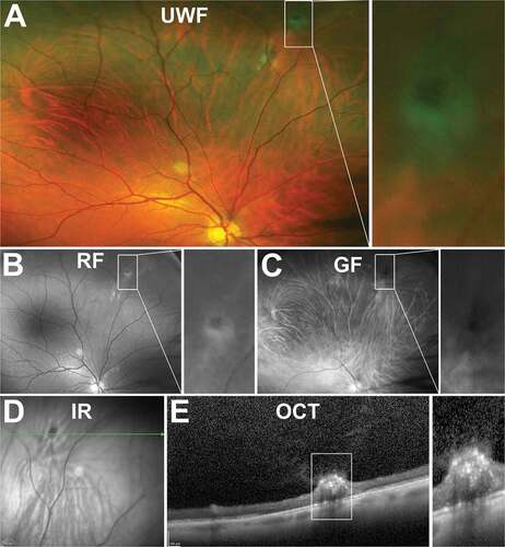 Figure 16. 47 year old Caucasian male with non-cystic vitreoretinal tuft. (A) UWF imaging indicates the well demarcated lesion in the superonasal peripheral retina, visible on (B) red-free and (C) green-free images. (D) On infrared imaging, the lesion appears dark and corresponding (E) peripheral OCT highlights the hyperreflective apical tip of the tuft extending into the vitreous with disturbance to the underlying photoreceptor and RPE layers. Abbreviations as in Figure 3.