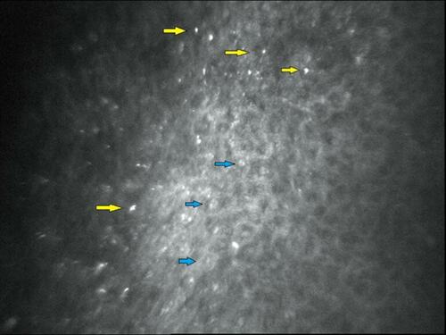 Figure 4 In vivo confocal microscopy image (400×400 μm) of a BCD patient (subepithelium area). The crystals (yellow arrows) were up to 24 μm in length and 16 μm in width and barely distinguishable from keratocytes nuclei (blue arrows).