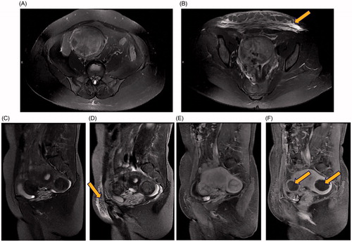 Figure 1. Pre-operative and post-operative MRI. T2-weighted images of a 51-year-old woman with uterine fibroids but no abdominal wall scar. (A) Axial view before HIFU treatment, indicating no abnormal signals in the abdominal wall; (B) Hyperintense signals on the axial view after HIFU treatment (indicated by the arrowhead); T2-weighted images and contrast-enhanced MRI images of a 41-year-old case with uterine fibroids and an abdominal wall scar. (C) Sagittal view before HIFU treatment, indicating no abnormal signals in the abdominal wall; (D) Hyperintense signals in the sagittal view after HIFU treatment (indicated by the arrowhead); (E) Sagittal contrast-enhanced image before HIFU treatment; (F) Sagittal contrast-enhanced image after HIFU treatment, uterine fibroids located in the anterior wall and posterior wall of the uterus were almost completely ablated with non-perfusion area in the fibroids (indicated by the arrowhead).