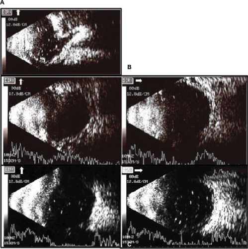 Figure 3 (A) B-scan showed higher CD over the upper area with a shallower one over the lower area on vertical view. (B) On postoperative day 2, just the upper peripheral CD with an obvious flat but thick choroid over the posterior pole appeared on horizontal view from B-scan. (C) B-scan showed the CD totally resolving from the posterior pole to the periphery, with a residual one over the upper area more anteriorly.