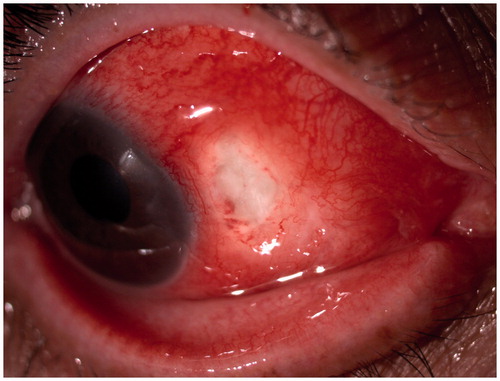 Figure 1. Active anterior scleritis before treatment.