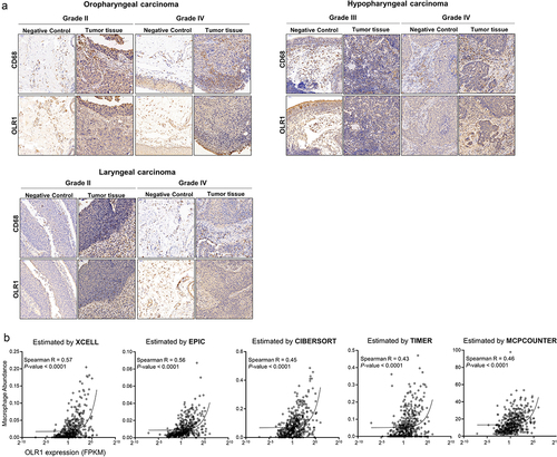 Figure 2. Correlation of intratumoral OLR1 expression and macrophage infiltration. (A) Immunohistochemistry staining analysis of OLR1 and CD68 in HNSCC tumor samples. (B) Correlation of estimated tumor-associated macrophage abundances by using different methods and OLR1 expression value based on TCGA database.