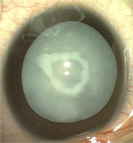 Figure 3 Total cataract with central anterior capsular plaque.