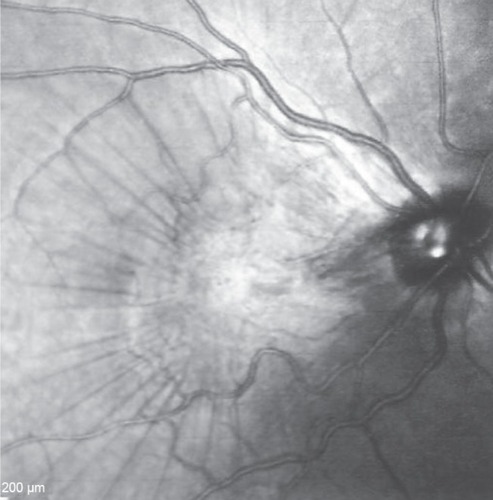 Figure 3 Infrared photograph of the right posterior pole.