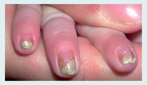 Figure 5. Distal subungual onychomycosis caused by Candida in a newborn: onycholysis and subungual hyperkeratosis with yellow discoloration of several fingernails.