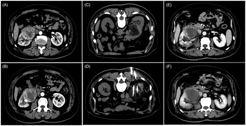 Figure 6. A 60-year-old man with a massive tumor on the right kidney accompanied by multiple (lung and bone) metastases who underwent cryoablation combined with sorafenib. (A, B) Preoperative CT scans show that the tumor was located in the subrenal pole and involved the renal hilum, with the largest tumor diameter of 6.8 cm. (C, D) CT scans show incomplete ablation of the renal hilum tumor during cryoablation. (E, F) CT scan at 1 month after cryoablation shows that most of the tumor body is completely necrotic and that there is residual tumor tissue in the renal hilum.