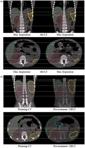 Figure 2. Examples of the imaging data sets used for the motion uncertainty assessment for both intra-fraction (A, top row) and inter-fraction (B, bottom row) uncertainties for one patient. Dashed lines are used to help to identify the borders of the delineated structures: liver, kidney, spleen and one surgical clip.