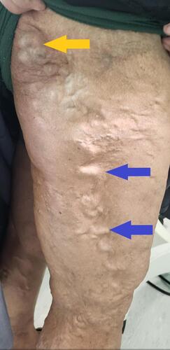Figure 2 Lateral marginal vein (blue arrows) and gluteal vein (yellow arrow) seen in patient with Klippel-Trénaunay syndrome. The lateral marginal vein is considered pathognomonic of the disease.