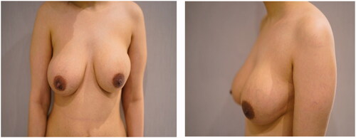 Figure 5. (a,b) Obvious distortion in the shape of the left breast.