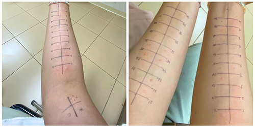 Figure 2 Skin prick test.