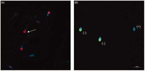 Figure 1. Evaluation of sperm capacitation status and acrosome reaction induction. (A) 4G10 phosphorylation patterns. Note the signal in the equatorial subsegment and acrosomal region (white arrow), pattern considered as ‘high capacitated’. (B) PNA-label. Spermatozoa with fluorescence in the acrosomal region was considered not reacted (−) and those with faint labelling in the equatorial segment were regarded as acrosome reacted (+).