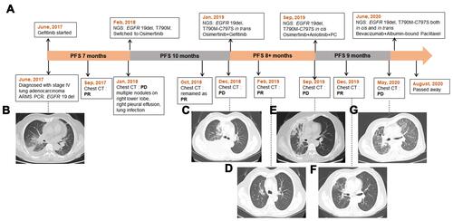Figure 1 The timeline of the patient’s treatment history and the response of the tumor lesions. (A) the timeline of treatments; (B) the chest CT image at initial diagnosis; (C) disease progression (PD) on osimertinib; (D) partial response (PR) to osimertinib+ gefitinib; (E) PD on osimertinib+ gefitinib; (F) PR to the treatment of osimertinib+ anlotinib+ chemotherapy; (G) PD on osimertinib+ anlotinib+ chemotherapy.