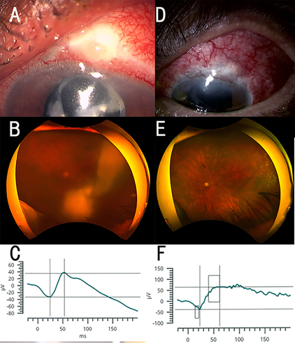 Figure 1 Case 1. This patient developed exogenous endophthalmitis after undergoing trabeculotomy. Slit-lamp images, fundus photographs, optical coherence tomographic (OCT) images, and electroretinograms (ERGs) before and during the bleb-associated endophthalmitis are shown. (A) Slit-lamp image on the initial visit showing an avascular bleb, conjunctival hyperemia, and a mild upper corneal opacity. (B) Fundus photograph 1 day before the surgery showing that the fundus was not visible due to vitreous opacity. (C) Mixed rod-cone electroretinogram (ERG) on the initial visit. The a- and b- wave amplitudes are moderately attenuated. (D) Slit-lamp image 2 weeks after surgery showing reduced height of the avascular bleb and slightly decreased injection. (E) Fundus photograph 4 days after surgery showing an intact retinal circulation and pale optic disc. (F) Mixed rod-cone ERG 3 days after the surgery. The a- and b-wave amplitude is larger than the preoperative values, and the b/a ratio is not changed at approximately 2.0 postoperatively. The implicit time of both waves was not altered. Note that the vertical axis representing the amplitude has a different scale.