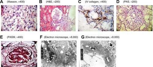 Figure 1 Pathological examination of the kidney by using light microscopy and electron microscopy.