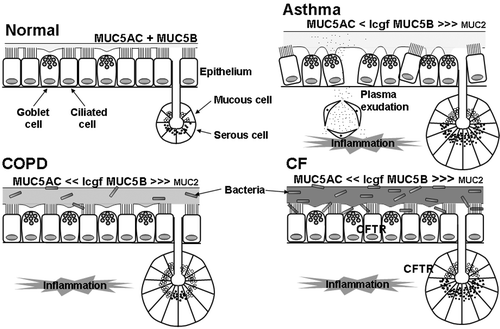 Figure 2. Putative differences in pathophysiology of the airway mucus hypersecretory phenotype in asthma, chronic obstructive pulmonary disease(COPD) and cystic fibrosis (CF). Compared with normal, in asthma there is airway inflammation, increased luminal mucus, with an increased ratio of MUC5B (low charge glycoform (lcgf)) to MUC5AC, possibly small amounts of MUC2 present in the mucus, epithelial ‘fragility’ with loss of ciliated cells, marked goblet cell hyperplasia, submucosal gland hypertrophy (although without a marked increase in mucous to serous ratio), ‘tethering’ of mucus to goblet cells, and plasma exudation. In COPD, there is airway inflammation, increased luminal mucus, goblet cell hyperplasia, submucosal gland hypertrophy (with an increased proportion of mucous to serous acini), an increased ratio of lgcf MUC5B to MUC5AC above that in asthma, possibly small amounts of MUC2 in the mucus, and a susceptibility to infection. In CF, there is airway inflammation, increased luminal mucus, goblet cell hyperplasia, submucosal gland hypertrophy, an increased ratio of lgcf MUC5B to MUC5AC, small amounts of MUC2 in the mucus, and a marked susceptibility to infection. Many of these differences require confirmation (or otherwise) by data from greater numbers of subjects.