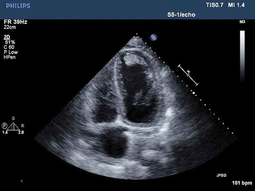 Figure 1. Transthoracic echocardiogram in the apical four-chamber view showing layered echogenic material extending from the mid to distal anterior lateral wall, anterior wall, descending inferior wall and apex which represented a layered thrombus.