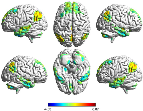 Figure 3 Brain areas with differences in ReHo values between BD and HCs groups. Compared with HCs, increased ReHo value in the left middle temporal gyrus, posterior cingulate gyrus, inferior parietal gyrus, and AG, and decreased in the left dorsolateral superior frontal gyrus in patients with first-episode bipolar patients. red denotes a higher ReHo value.