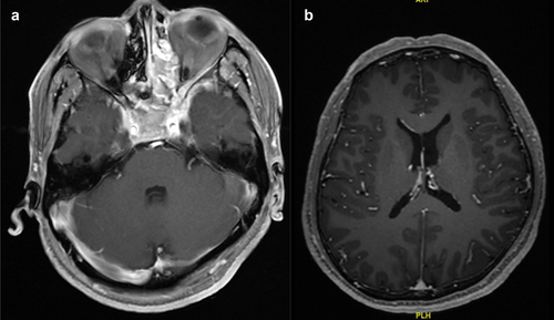Figure 1. (a). Magnetic resonance imaging (MRI) showed the nasopharyngeal mass occupies the right pharyngeal recess, bilateral pterygopalatine fossa, posterior nostrils, left posterior nasal cavity, ethmoid sinus, sphenoid sinus, bilateral cavernous sinus, and involves the left Merkle cavity and Gasser ganglion. (b). Baseline cranial MRI of this patient showed no signs of meningeal metastasis.