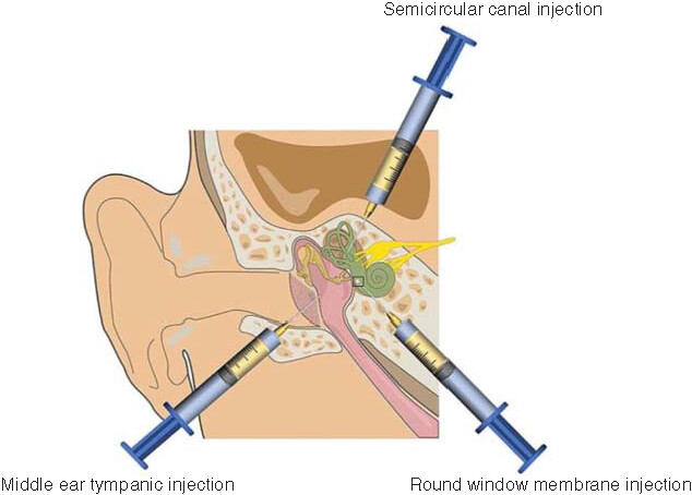 Figure 3. Common methods of drug delivery by inner ear injection.Current common methods of inner ear drug delivery include middle ear tympanic injection, round window membrane injection and semicircular canal injection.