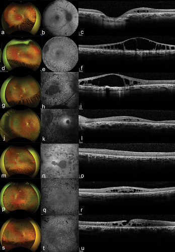 Figure 1. Typical findings in patients with mild Zellweger spectrum disorder (ZSD) with biallelic variants c.2528 G>A (p.Gly843Asp) in PEX1 on fundus photographs, fundus autofluorescence (FAF), and spectral-domain optical coherence tomography (SD-OCT).