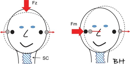 Figure 7 A simplistic view of how the skull deforms after a low-frequency impact from midline Fz (or vertex) and from the mastoid Fm.