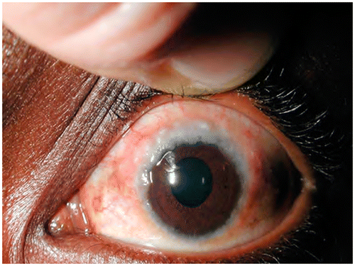 Figure 13: Limbal vernal keratoconjunctivitis