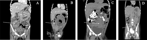 Figure 2 CT scan showing different visceral masses (white arrows) involving cecum (A), transverse colon (B), sigmoid and liver, thickened bowel wall (C), and encapsulated liver lesion with central fluids (D).