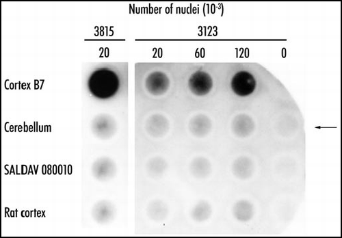 Figure 3 Polymeric state of expanded huntingtin in Huntington disease. Purified nuclei of cortex and cerebellum of Huntington disease patient 3815 and of controls were extracted with concentrated formic acid. The suspension was diluted 10-fold in Tris/SDS/2-ME, boiled for five minutes, and immediately passed through cellulose acetate filters. The retained material was visualized with antibody 1C2. Control SALDAV 080010 was a lymphoblast line possessing a huntingtin with 79 glutamine residues. Rat cortex, whose huntingtin possesses Q8, should not be stainable by 1C2. Cortex 3815: 20,000 nuclei gave a strong signal. The corresponding cerebellum, SALDAV 080010, and rat cortex gave weak signals. Cortex of patient 3123: 120,000 nuclei produced a weaker signal than 20,000 nuclei of cortex 3815, in keeping with a number of inclusions smaller in case 3123 than in case 3815. Arrow indicates control without nuclei. Resistance to formic acid of the cortical polymers of the two patients strongly suggests stabilization of the polymers by covalent bonds. Reproduced from Iuchi et al.Citation30