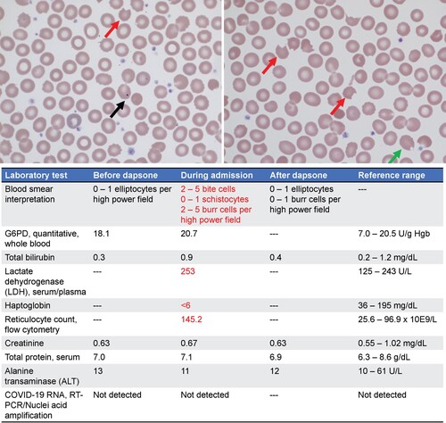 Figure 3. (Top) Patient’s peripheral blood smear at hospital admission. Red arrows indicate bite cells. Black arrow indicates a Howell-jolly body. Green arrow indicates a blister cell. (Bottom) Pertinent patient laboratory values before initiating, during treatment and after termination of dapsone therapy. Reference ranges are included to indicate normal values. Red text highlights abnormal lab values.