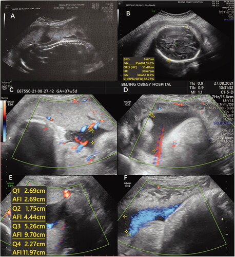 Figure 1. (A–F) Ultrasound indicating that the fetus was developing normally during the whole gestation.