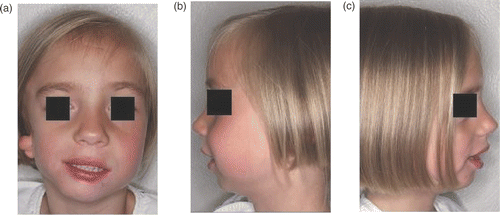 Figure 1. Five-year-old patient with a right facial hemiatrophy, Grade IB (classification of Pruzansky): (a) anterior facial view; (b) left profile; (c) right profile. [Color version available online.]